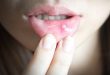 jenis-jenis sariawan di bibir